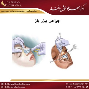 جراحی بینی باز