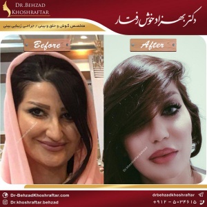 رینوپلاستی