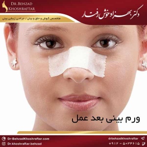 ورم بینی بعد عمل دکتر بهزاد خوش رفتار