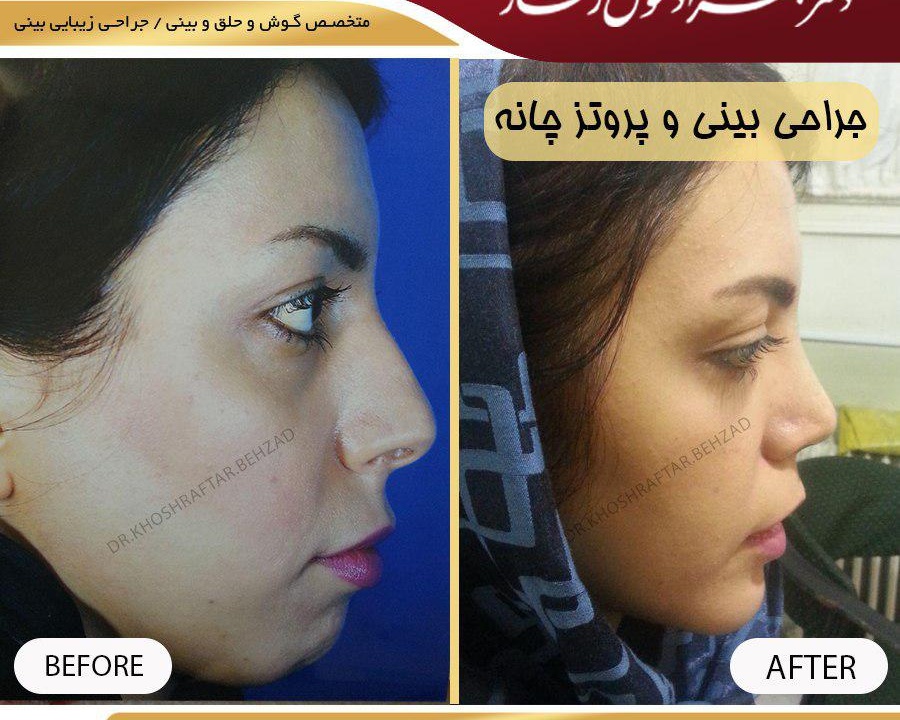 جراحی بینی گوشتی