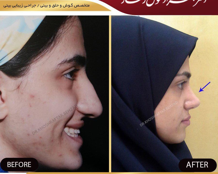 جراحی بینی استخوانی
