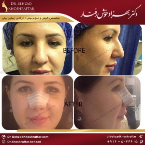 ورزش بعد از جراحی بینی