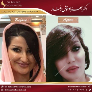 جراحی بینی طبیعی