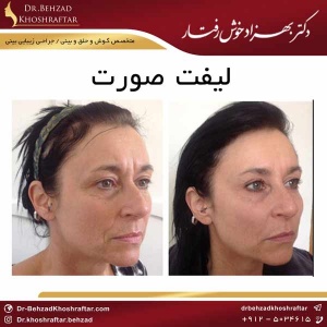 لیفت صورت دکتر بهزاد خوش رفتار