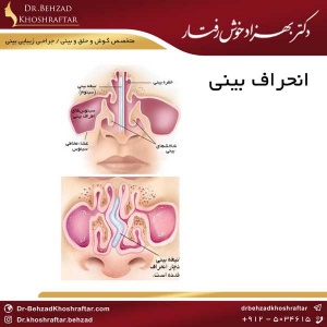 تفاوتهای عمل بینی کج و انحراف بینی دکتر بهزاد خوش رفتار