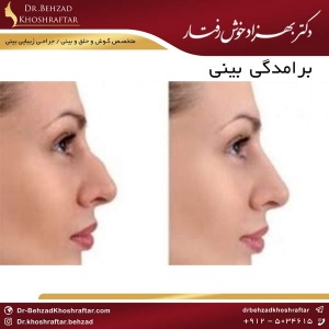 برامدگی بینی دکتر بهزاد خوش رفتار