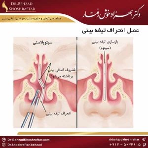 تفاوتهای عمل بینی کج و انحراف بینی دکتر بهزاد خوش رفتار