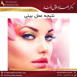 نتیجه عمل بینی دکتر بهزاد خوش رفتار