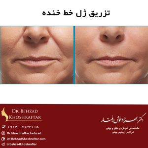 تزریق ژل خط خنده
