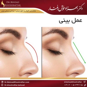 عمل بینی دکتر بهزاد خوش رفتار