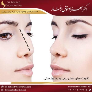 تفاوت میان عمل بینی و رینوپلاستی دکتر بهزاد خوش رفتار