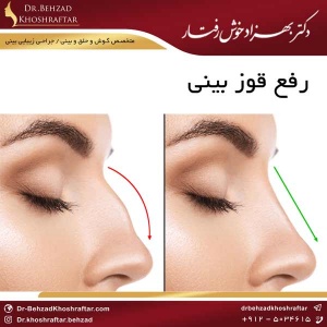 تفاوت میان عمل بینی و رینوپلاستی دکتر بهزاد خوش رفتار