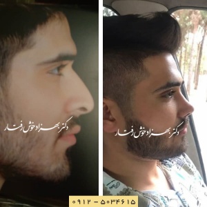 بهترین جراح بینی گوشتی در تهران را بشناسید