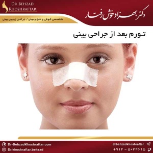 عمل زیبایی بینی دکتر بهزاد خوش رفتار
