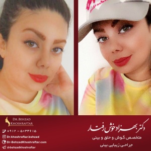 سن مناسب برای جراحی بینی