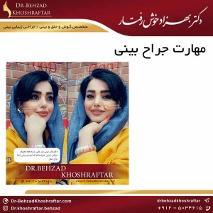 مهارت جراح بینی دکتر بهزاد خوش رفتار 